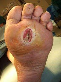 dr-foot_diabetic-foot-issue_Problem