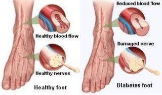 dr-foot_diabetic-foot-issue_Treatment