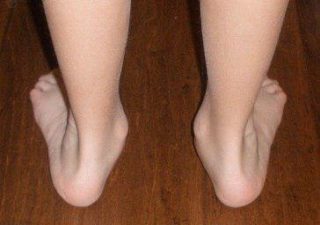 dr-foot_flatfoot_Treatment