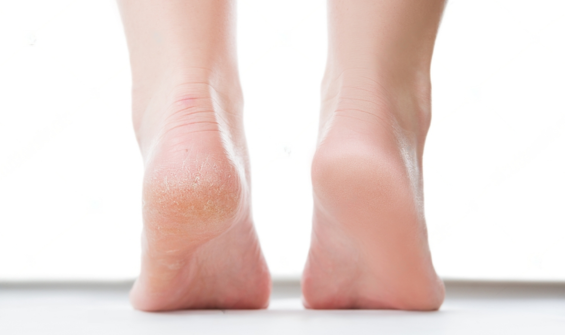 Understanding Calluses: Causes, Treatment, and Prevention